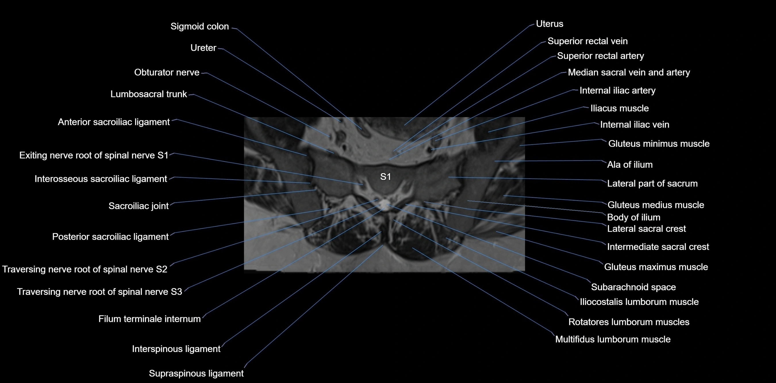 MRI sacrum, coccyx and sacroiliac joint axial cross sectional anatomy 3T  radiology  image-img-00001-00017.webp